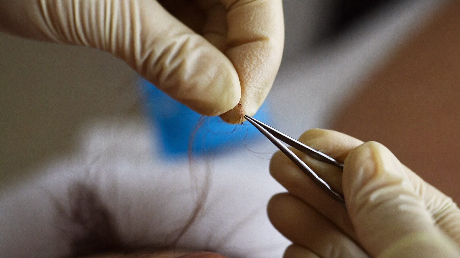 Gloved hands holding a single hair graft with fine forceps