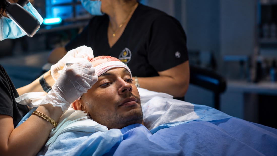 Implanter pen placing a graft at the front hairline during a DHI hair transplant at Nova Medical in Chicago