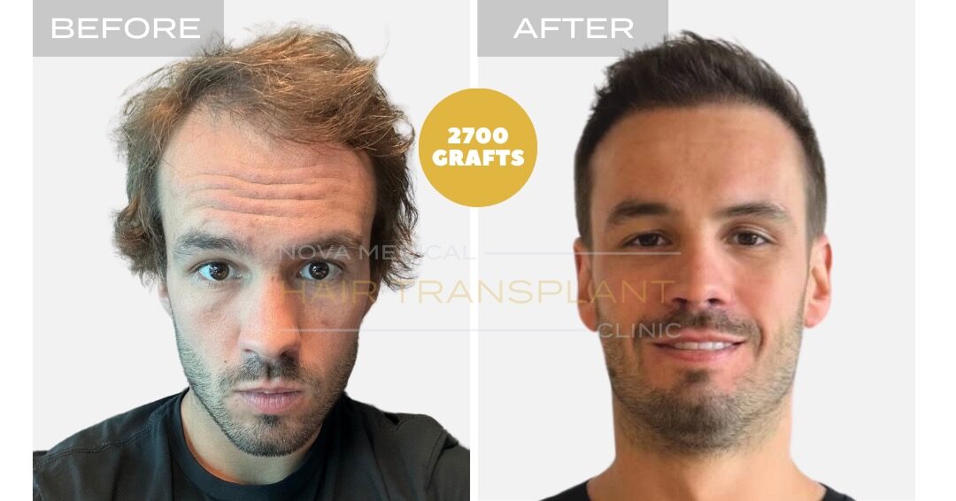 Before and after photos of a hair restoration patient, case 1 - Nova Medical Hair Transplant Chicago