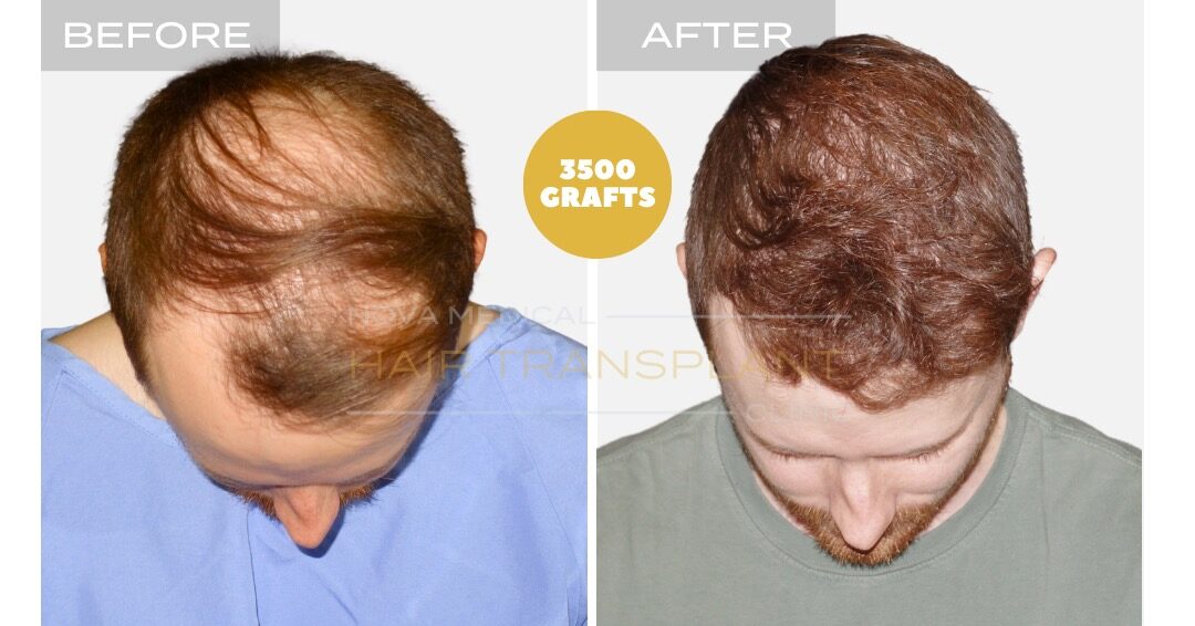 Before and after photos of a hair restoration patient, case 2 - Nova Medical Hair Transplant Chicago