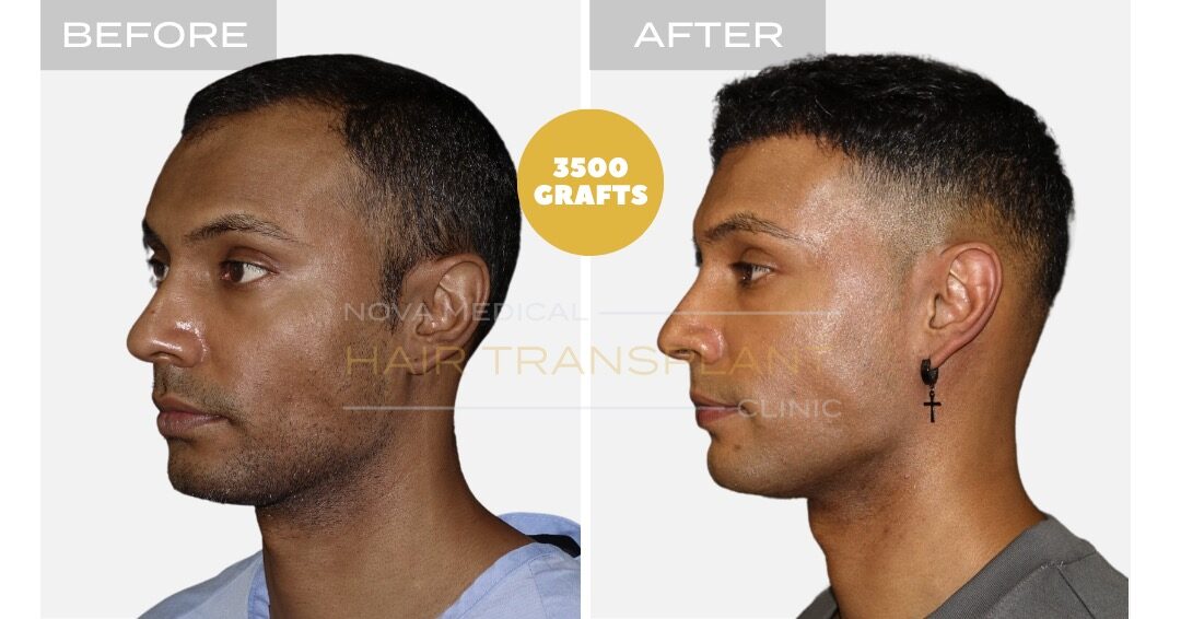 Before and after photos of a hair restoration patient, case 3 - Nova Medical Hair Transplant Chicago
