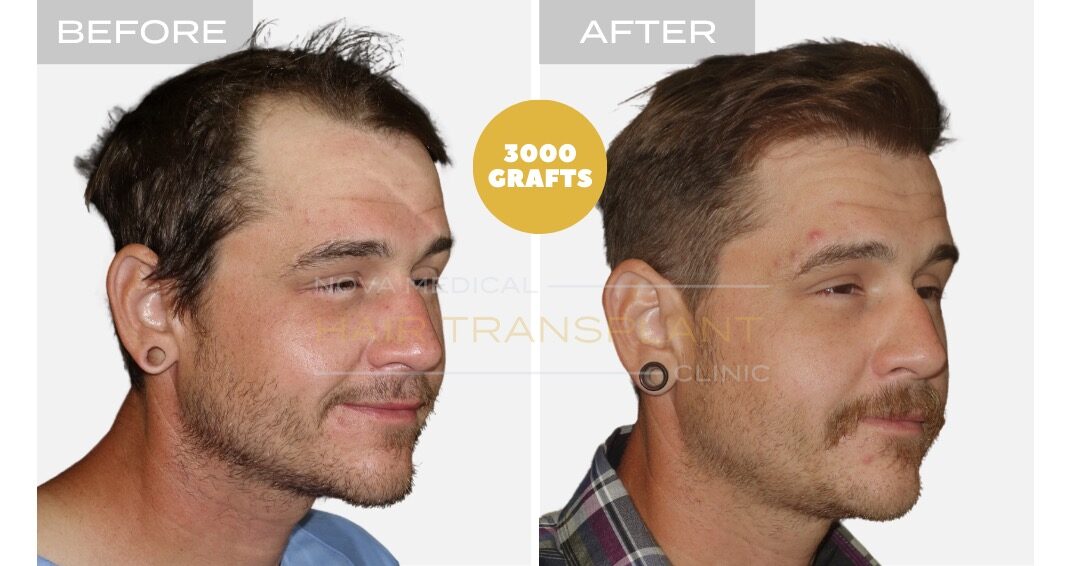 Before and after photos of a hair restoration patient, case 4 - Nova Medical Hair Transplant Chicago