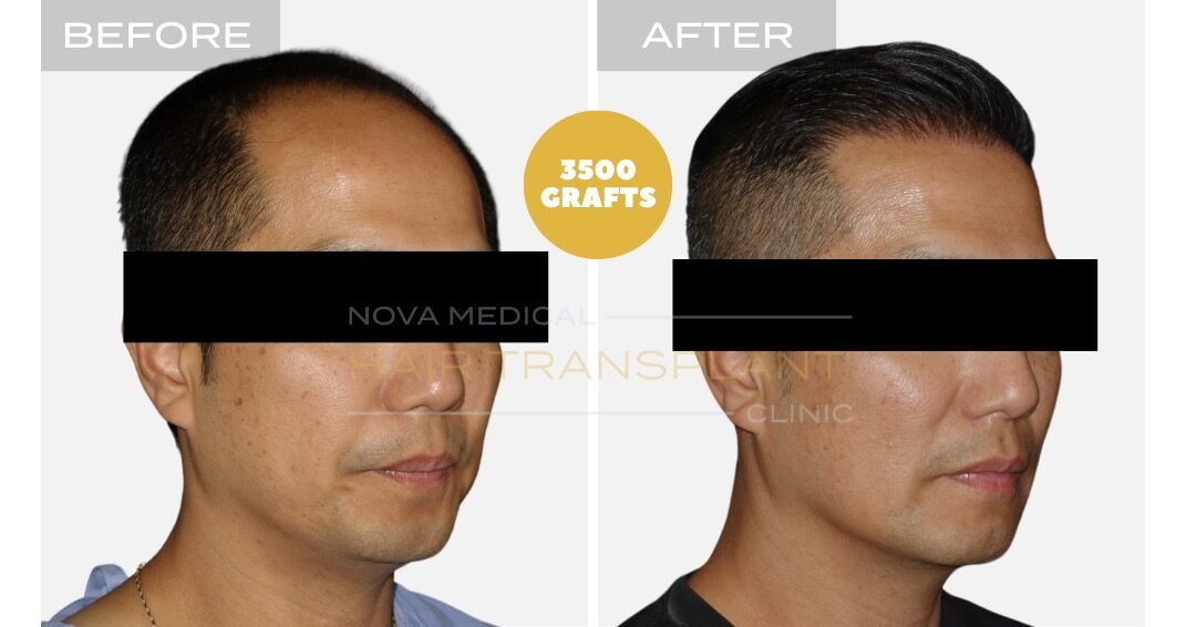 Before and after photos of a hair restoration patient, case 5 - Nova Medical Hair Transplant Chicago