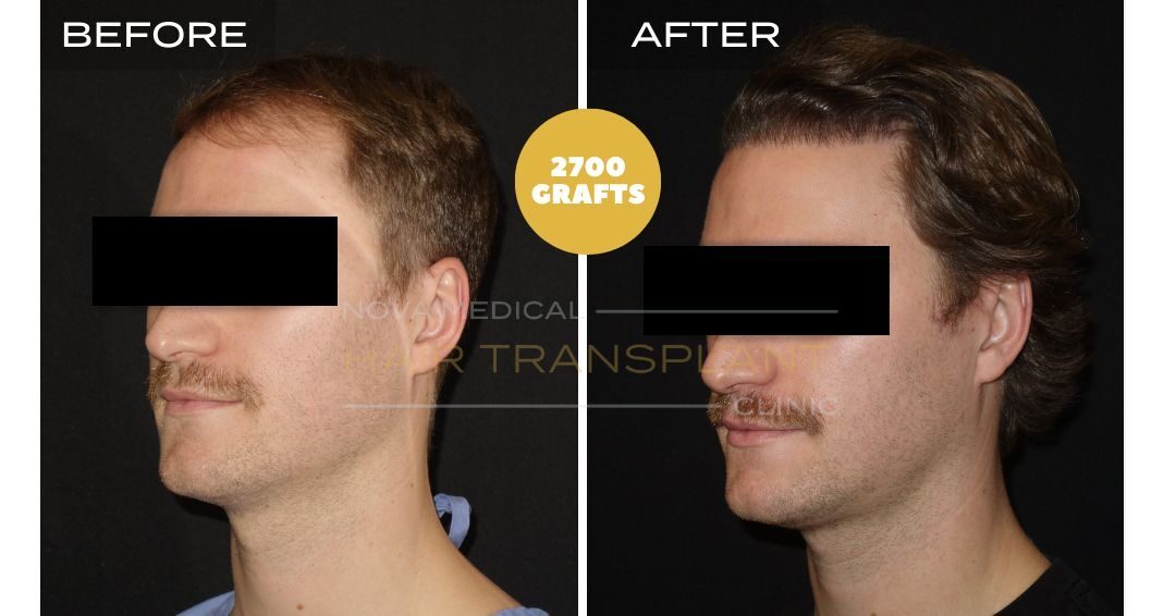 Before and after photos of a hair restoration patient, case 5, alternate angle - Nova Medical Hair Transplant Chicago